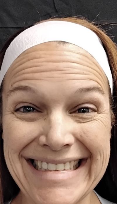 before photo of female patient before Botox/Xeomin front view case 1978