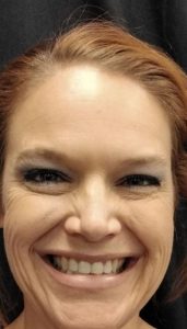 After photo of female patient after Botox/Xeomin procedure front view case 1978