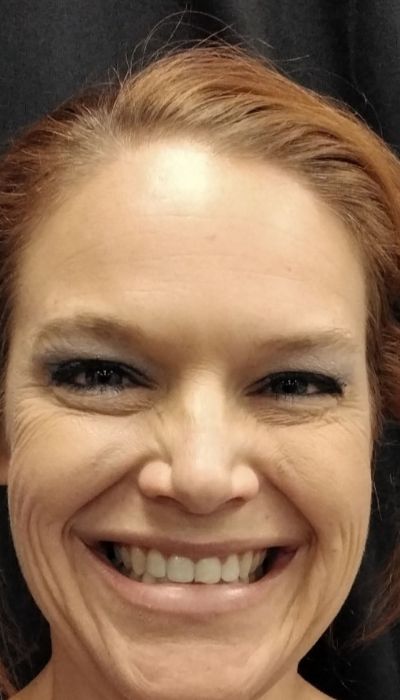 After photo of female patient after Botox/Xeomin procedure front view case 1978