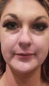 before lip augmentation female patient front view case 1985