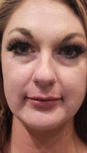 after lip augmentation female patient front view case 1985