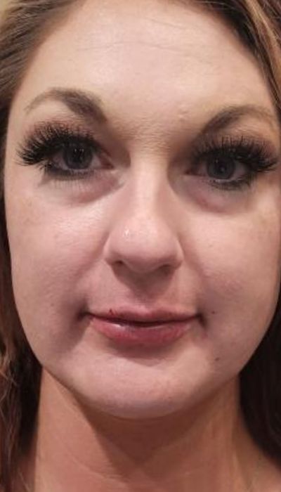 after lip augmentation female patient front view case 1985