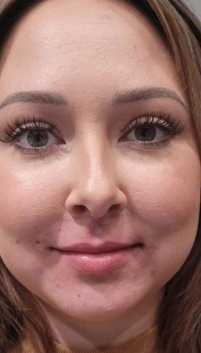 before lip augmentation female patient front view case 1988