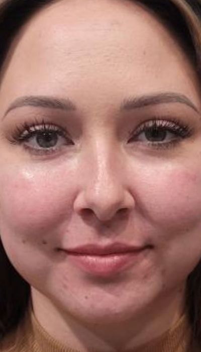 after lip augmentation female patient front view case 1988